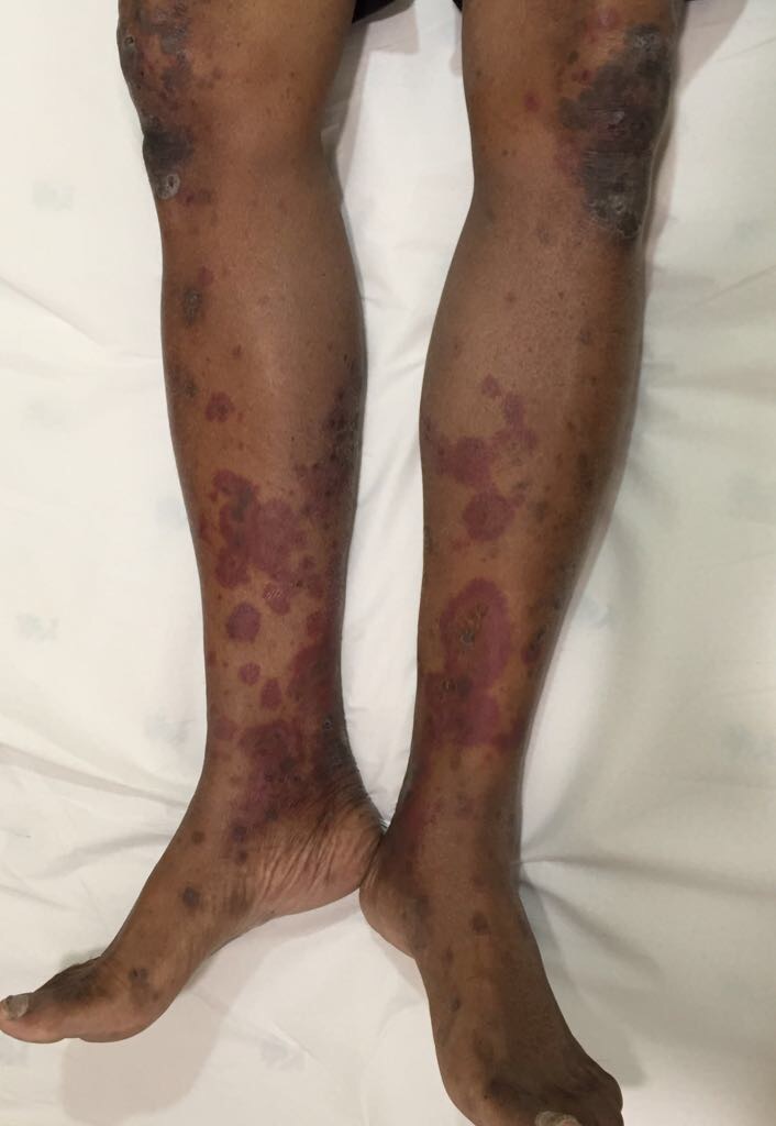A Rare Case Of Paraneoplastic Leukocytoclastic Vasculitis In Myelodysplastic Syndrome
